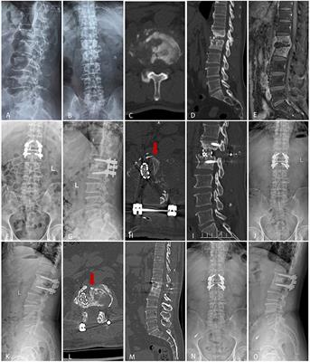 Spinous Process Combined With a Titanium Mesh Cage as a Bone Graft in the Stability Reconstruction of Lumbar or Lumbosacral Spinal Tuberculosis